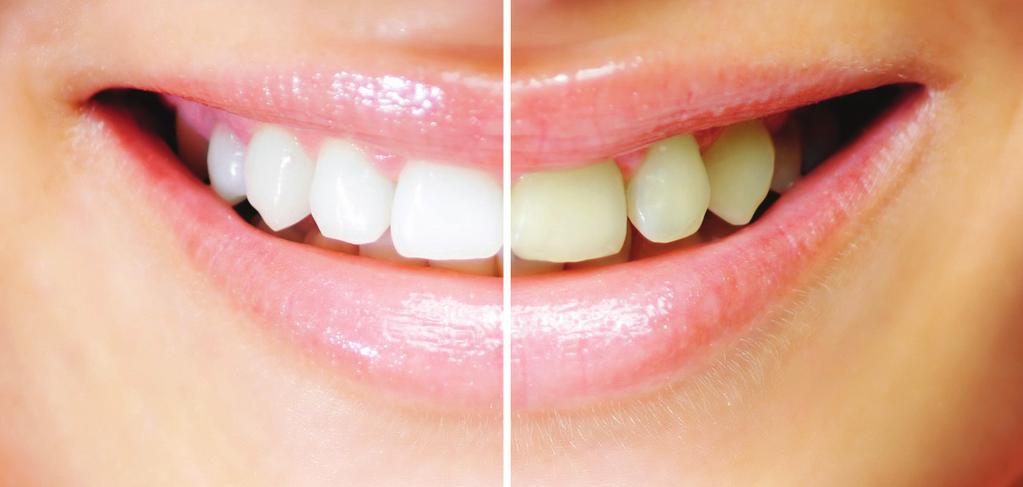 Få Ett Vitare Leende! TANDBLEKNING Gjort av en tandhygienist Nytt! Vilket leende skulle du föredra?
