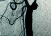 第一次頸動脈內皮剝離術於 1954 年完成 於 1971, 約執行 14,000 頸動脈內皮剝離術 ; 到 1985 年已完成 107,000 例手術 雖然頸動脈內膜切除術已有超過 50 年的歷史, 但遲至 10 多年前北美的 NASCET