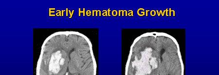 腦實質出血 : intracerebral hemorrhage Age Risk Factors Gender: more common in men Race: blacks, Orientals Previous CVA (any type) Alcohol consumption Cigarette smoking Drug: wafarin,aspirin Liver