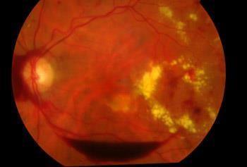Retinopati Normalt undersøkelse av øyebunn hver 1.-2. år Hos eldre, hvert 3.