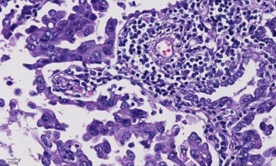 carcinoma Prevalence of PD-L1