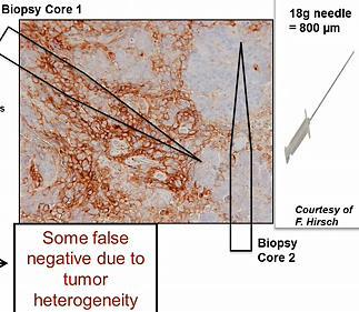 Heterogenitet intratumoralt 5-20% of patients PD-L1 neg Respond to therapy Falsk negativ?