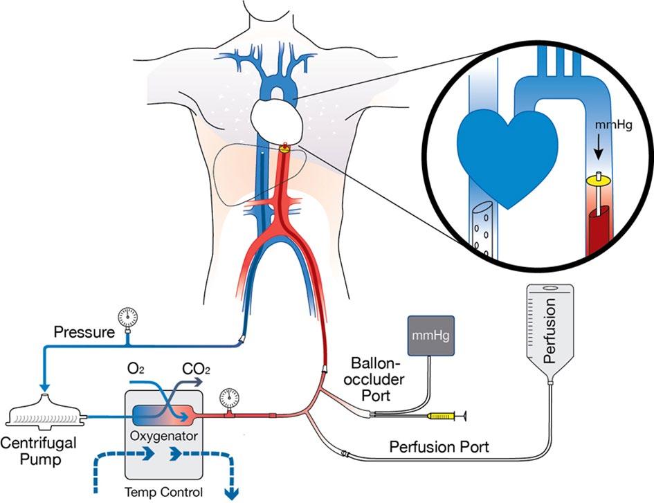 cdcd med normoterm regional perfusjon (controlled Donation after Circulatory Death) I 2017 har vi gjennomført 8 prosedyrer. Dette tilsvarer 9 % av totalt antall donasjoner.