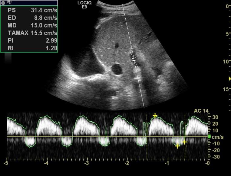 kompresjon/ Valsalva Hepatomegali Ascites Portal