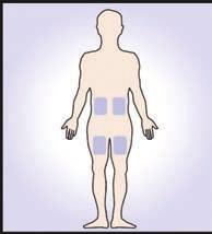 helsepersonell 1 Instruksjon for injeksjon av Metex penn 1. Injeksjonssteder Injeksjonssteder: Mage (ikke rundt navlen) eller utsiden av låret.