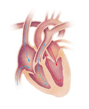 Lokalisasjon tumores Høyre atrium Trombe Metastase Myxom Sarkom Lipom Lymfom Hø ventrikkel Trombe Metastase Lipom Fibrom Rhabdomyom Lymfom Trombe Sarkom Lipom Perikard