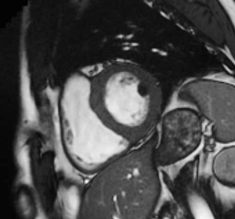 MR og CT ved kardiale tumores Utfyllende informasjon om Størrelse