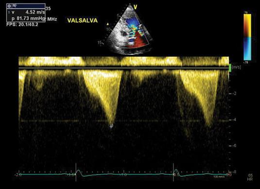 Valsalva manøver European Heart Journal