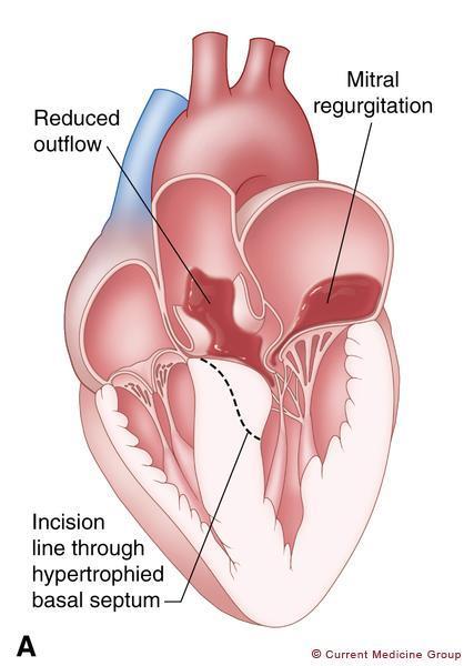 Resultater Septumreduserende behandling: Septal