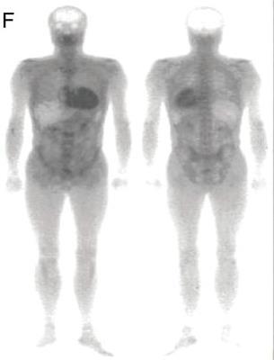 Kardial amyloidose vs HCM