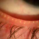 Lipidlaget Lipidlaget hindrer at tårefilmen fordamper. Lipidlaget produseres hovedsakelig fra de meibomske kjertlene som ligger langs kanten av øyelokkene.