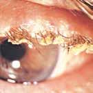 Mucinlaget Mucinlaget (slimlaget) produseres av begerceller som finnes i konjunktiva (bindehinnen som dekker øyet og øyelokkenes innside).
