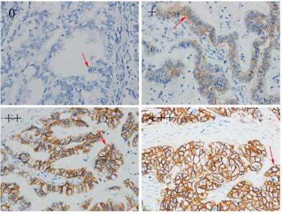 Her2 immun (CerbB-2) Dual SISH Qui et al., J Cancer 2017; 8(17):3531-3537 TNM-klassifisering TNM-klassifisering 7.