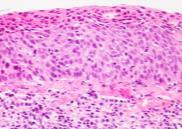 Premaligne tilstander i plate- og sylinderepitel (dysplasi/intraepitelial neoplasi og Barretts øsofagus) Malignitet (epiteliale