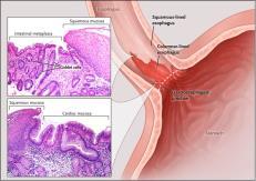 , British Society of Gastroenterology guidelines on the diagnosis and management of Barrett s oesophagus. Gut 2014 Jan;63(1):7-42 Stuart J. Spechler, M.D.