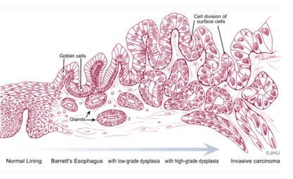 Dysplasiutvikling i sylinderepitel kombinasjon av cellulær