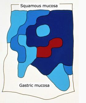 metaplasi Haggitt et al.