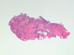 Gjennomsnittsalder 67 år Menn/kvinner 3:1 Kvinne, 70 år Sykehistorie: Funn av levermetastaser på CT thorax/abdomen.