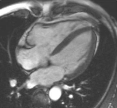 Arytmogen (HV) kardiomyopati MR er