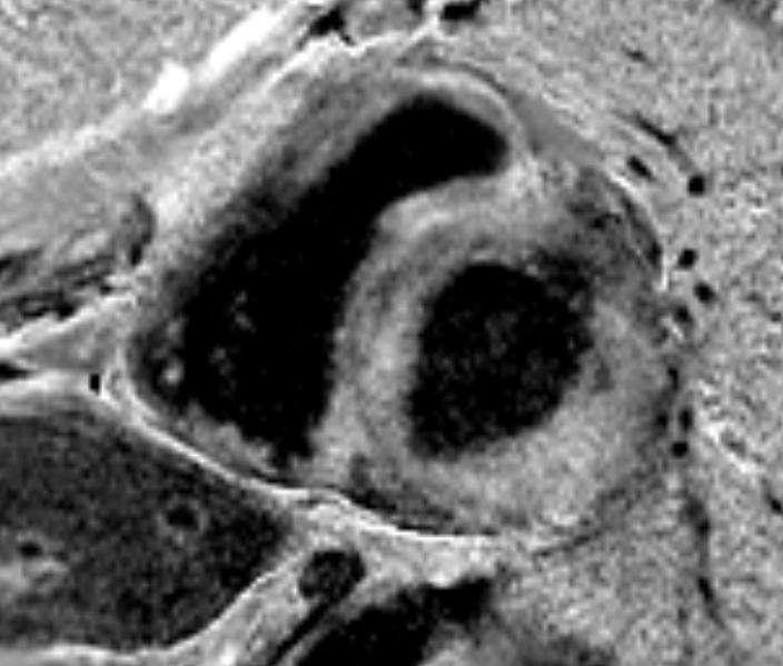 MR: Morfologi & diff-diagnoser Hypertrofi vs.