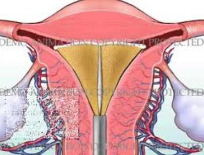 (transcervikal endometriereseksjon, hysteroskop) 70-80% Hysteroskopisk