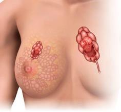 Cumulative incidence of solid malignancy after HL