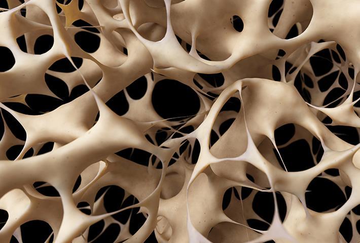 Benskjørhet - osteoporose Lav beintetthet beinvevet er mindre sterkt og mer utsatt for brudd. Ubalanse i forholdet mellom nedbryting og oppbygging av beinvev.