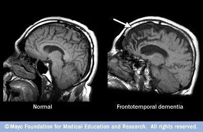 MRI/SPECT 51 Tiltak ved frontallappsdemens Ingen medikamenter for