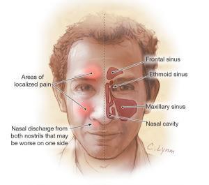 Nye forskningsprosjekter BASIC Better treatment for acute sinusitis in primary care.