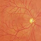 Enkel/bakgrunn diabetisk retinopati: mikroaneurisme, blødninger og kraftig eksudat Papilloødem (kronisk fase) Papilloødem (akutt fase) Glaukom optisk