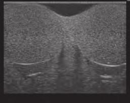 Scrotal ultralyd screening Visualisering av testikkelkreft Anatomi og patologi Scrotum,