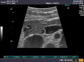 lever, bukspyttkjertel, milt og nyrer (hypoekkogen, hyperekkogen) Intraoperativ ultralyd Patologi Anterior Posterior Laparoskopisk ultralyd Simulerte cyster (1