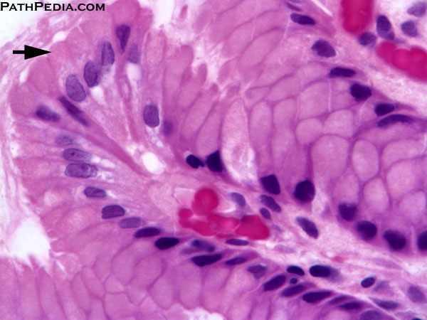 MINIMAL DEVIATION ADENOKARSINOM ACIS HPV + HPV - Adenokarsinom, vanlig type