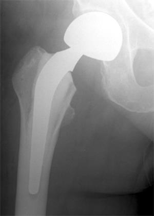 Risikofaktorer for hemiproteseinfeksjon -optimalisering?