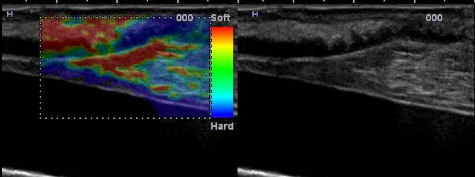 Vegglag -Elastisitet in vitro In vitro strain elastografi av en stenose.