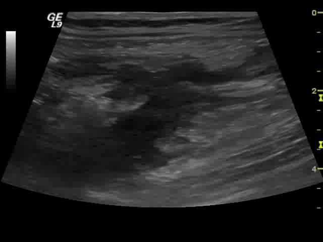 Komplikasjoner -Abscesser og