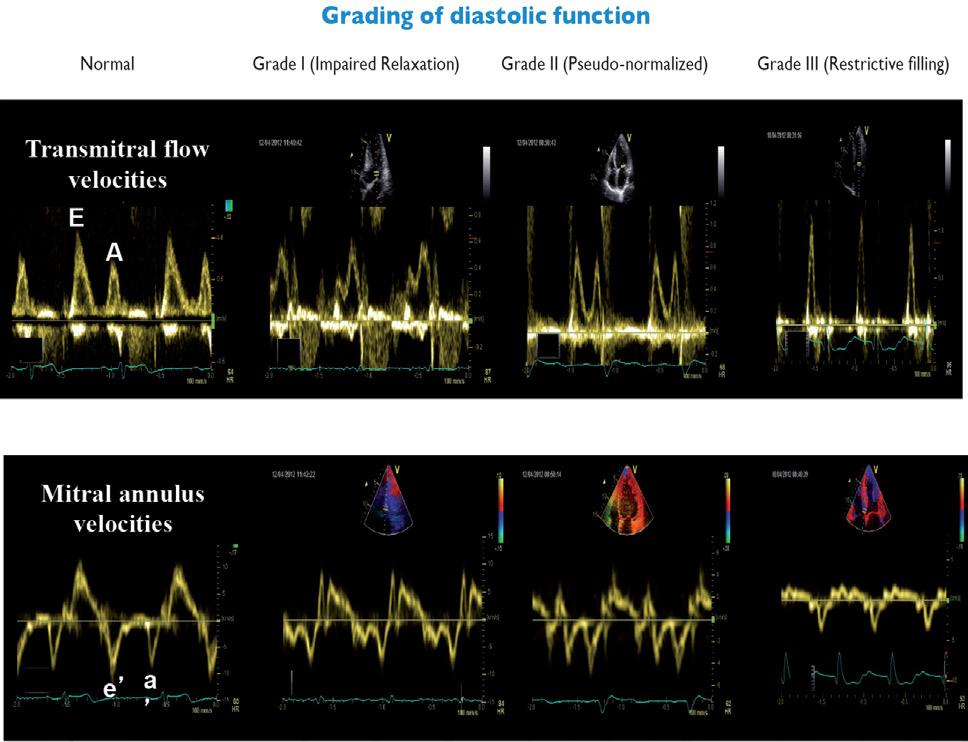 Figur 1: Gradering av diastolisk dysfunksjon: Kriteriene for grad I diastolisk dysfunksjon er mitral E/Aratio 0,8 samtidig med E 50 cm/s. Kriteriene for grad III diastolisk dysfunksjon er E/A 2.