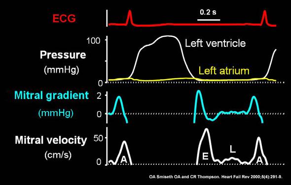 Når mitral E/A er mellom 0,9 og 1,9, trengs flere trykk-relaterte indekser for å kunne konkludere slik vist i figur 5. Man bruker forholdet mellom mitral E og e til evaluering av fylningstrykk.