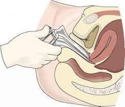 Inspiser vulva og ta eventuelt prøver Utfør