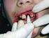 Tannskader i det primære tannsett. En undersøkelse i Buskerud