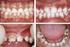 Karies i det primære tannsett betydning for oral og generell helse