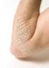 Psoriasis er en hudsykdom karakterisert ved røde områder i huden dekket av sølvhvite skjell.